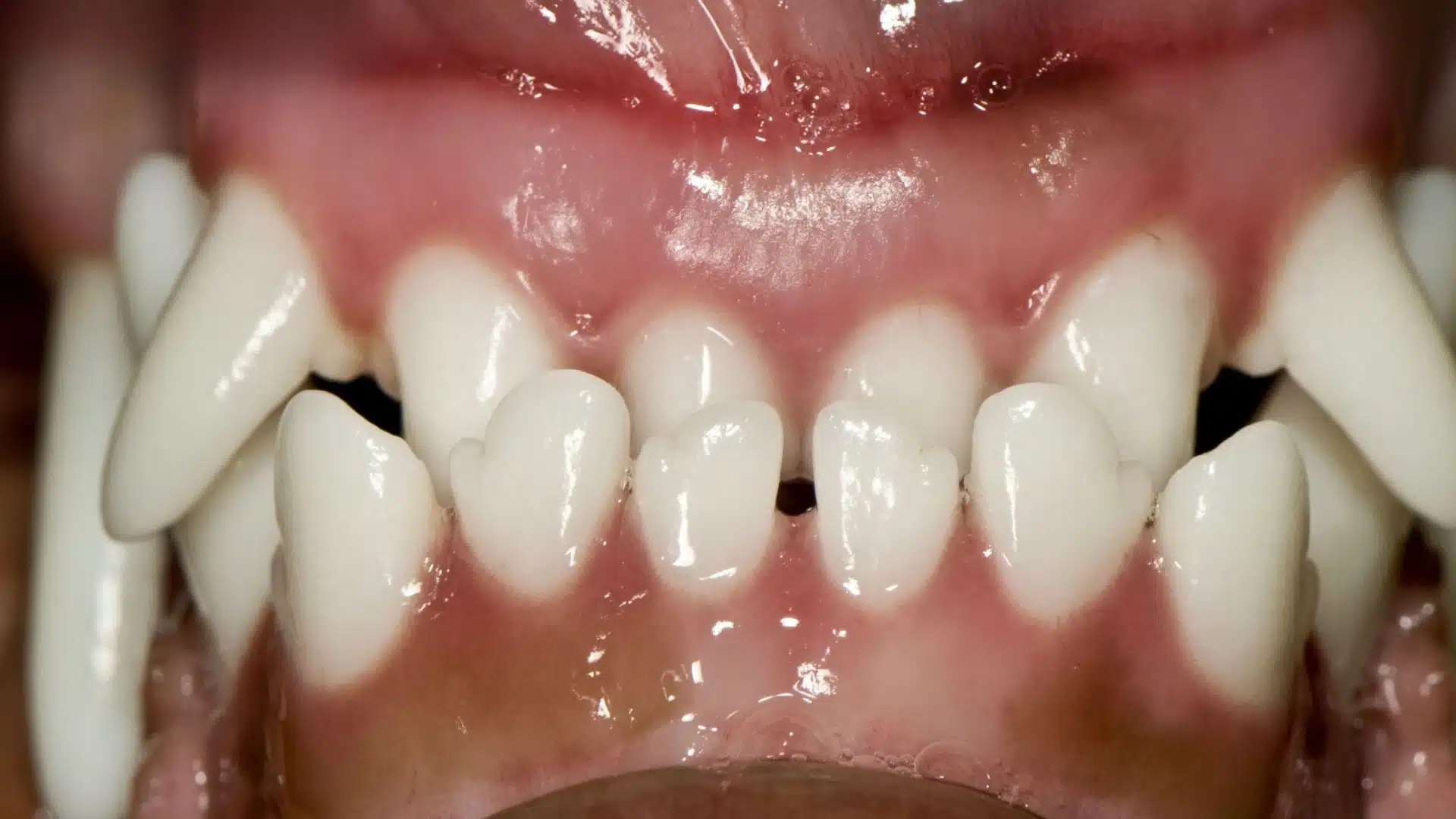 Close-up clinical view of a dog's anterior upper teeth showing prominent, pointed canines and underbite